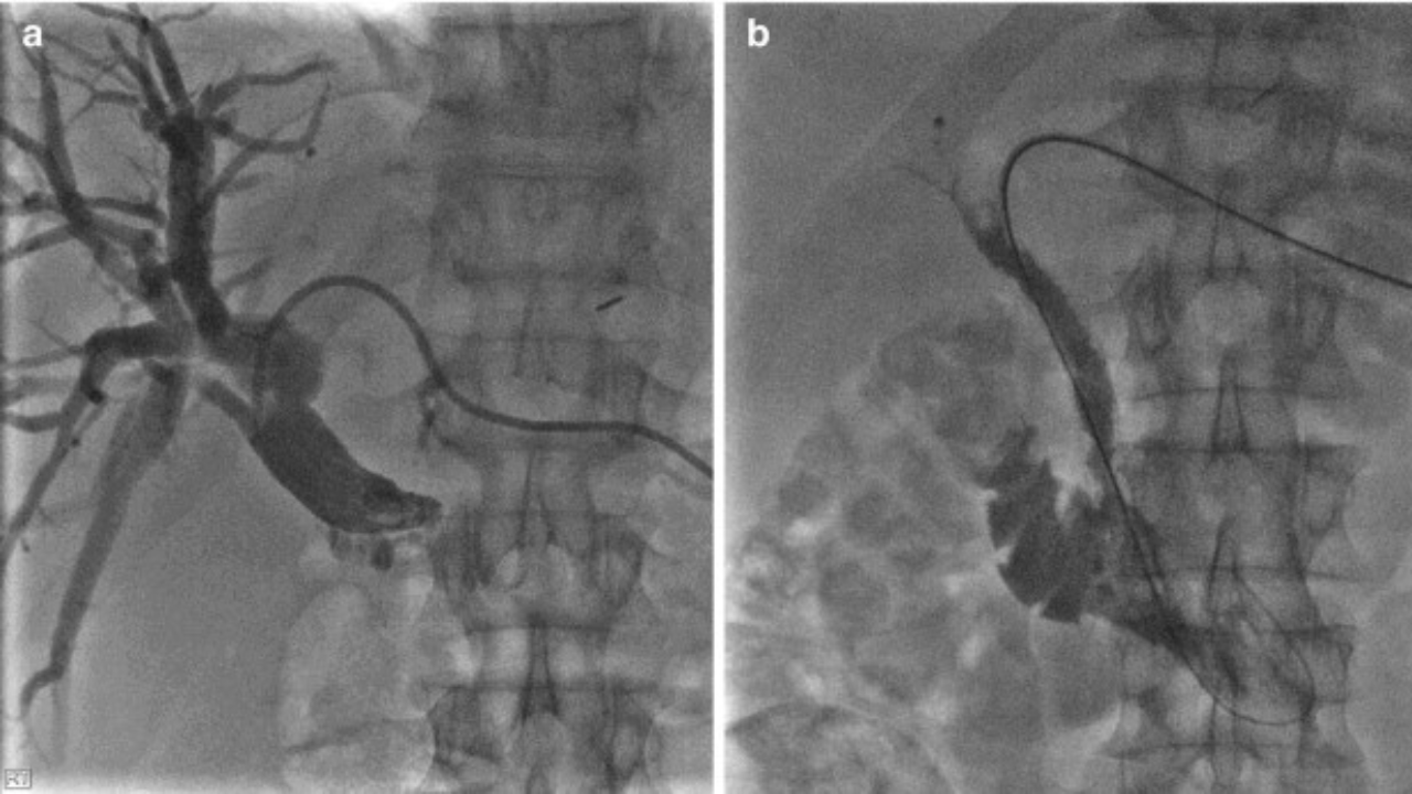 PTC & Biliary Stenting