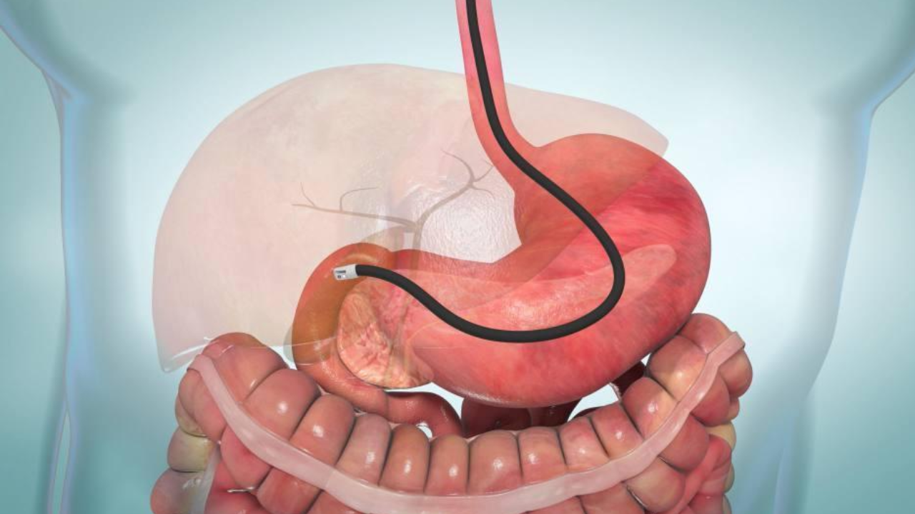 ERCP